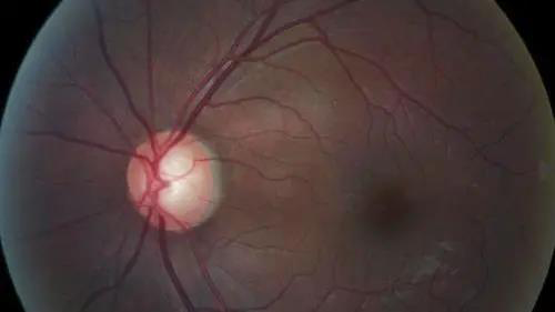 青光眼的克星来袭，，，，，助力患者远离视力的“窃贼”