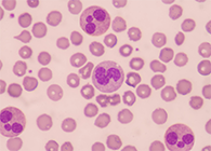 一种神秘颗粒被发明了！它能否成为败血症早筛标记物？？？？？？？