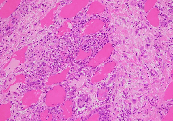 【亿万先生mr助力】治疗结节病的KBMAB-16获FDA批准临床